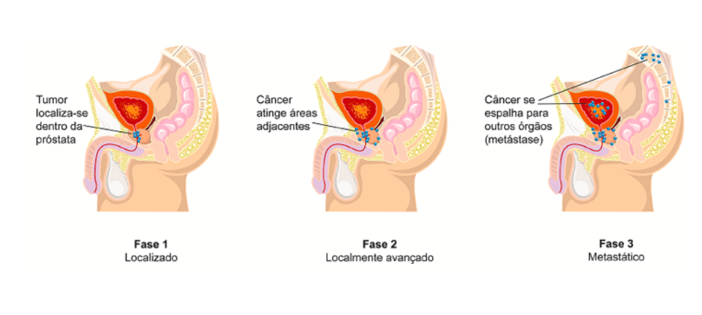 O câncer de próstata pode se espalhar para outros órgãos?